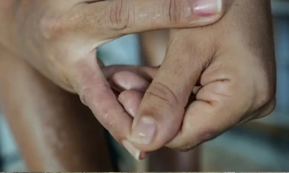 Dermatite atópica pode afetar pele, sono e autoestima; veja cuidados e tratamentos