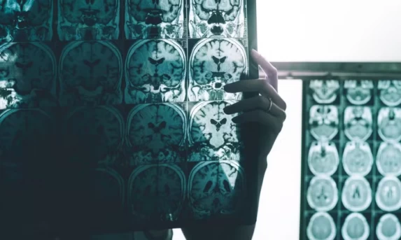 Estudo identifica células imunes que podem proteger o cérebro contra o avanço do Alzheimer