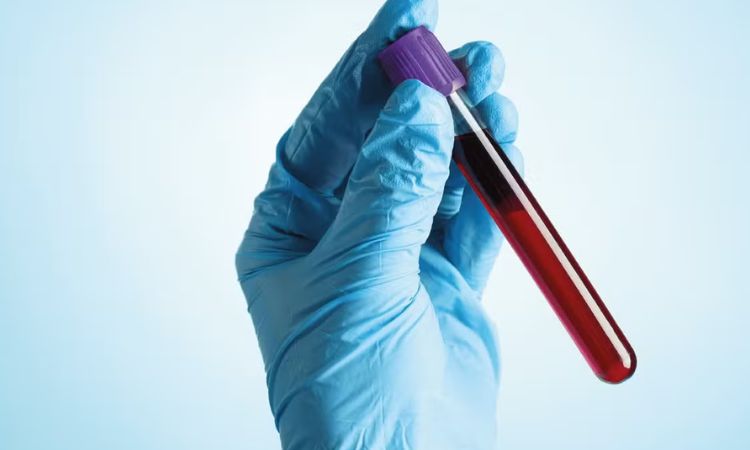 Exame de sangue pode auxiliar na investigação precoce do Alzheimer