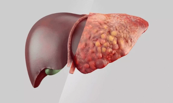 Gordura no fígado virou problema frequente: conheça sintomas e o tratamento