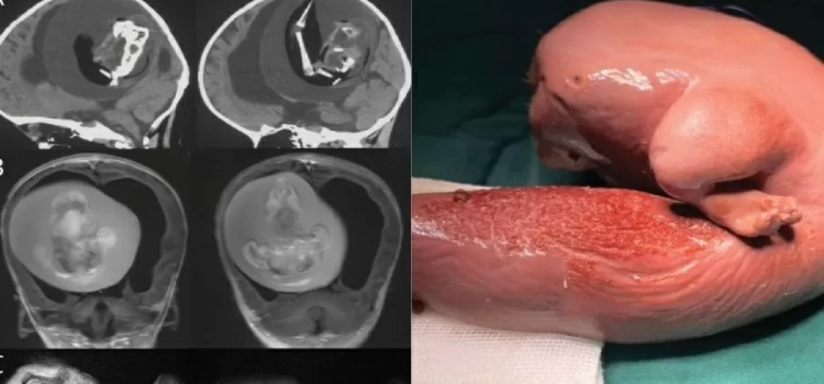INTERNACIONAL: Criança de 1 ano passa por cirurgia para retirar feto de seu cérebro.
