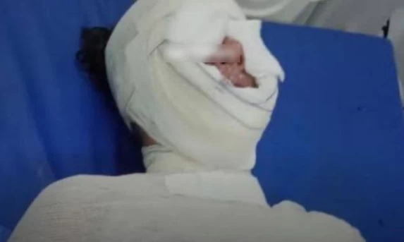 Mulher é gravemente ferida após panela de pressão explodir por choque térmico