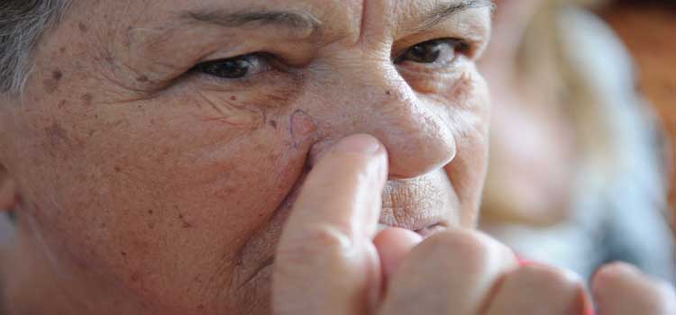 SAÚDE: Brasileiros devem redobrar cuidados no verão contra câncer de pele