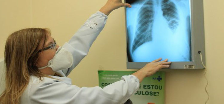 SAÚDE: Conselho aprova novas diretrizes para tratamento da tuberculose no SUS.