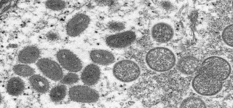 SAÚDE: Sobe para 142 o número de casos de varíola dos macacos.