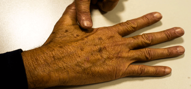 SAÚDE: Sociedade médica lança campanha sobre prevenção do câncer de pele.