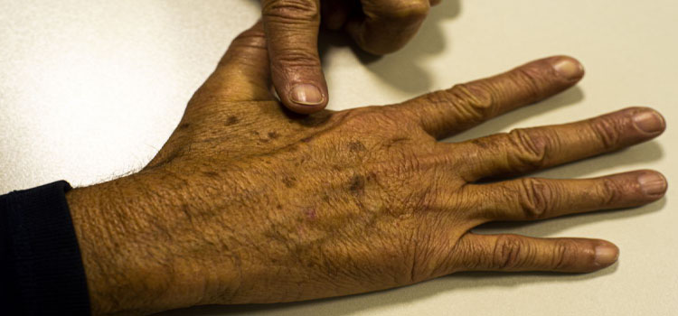 SAÚDE: Tecnologia para tratar câncer de pele é aprovada para uso no SUS.